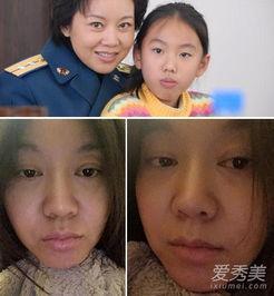 明星割双眼皮前后对比